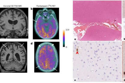 Alzheimer'la ilgili ilk kez bulaş kanıtı bulundu