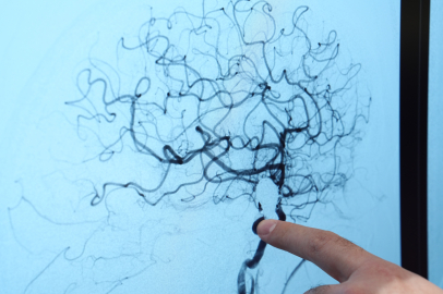 ‘Beyin anevrizması her 20 kişiden birinde görülebilir’